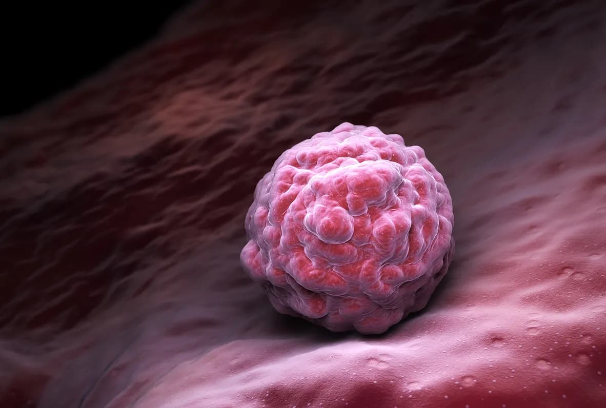 What Is a Fibroma?