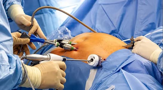 Hysterectomy: