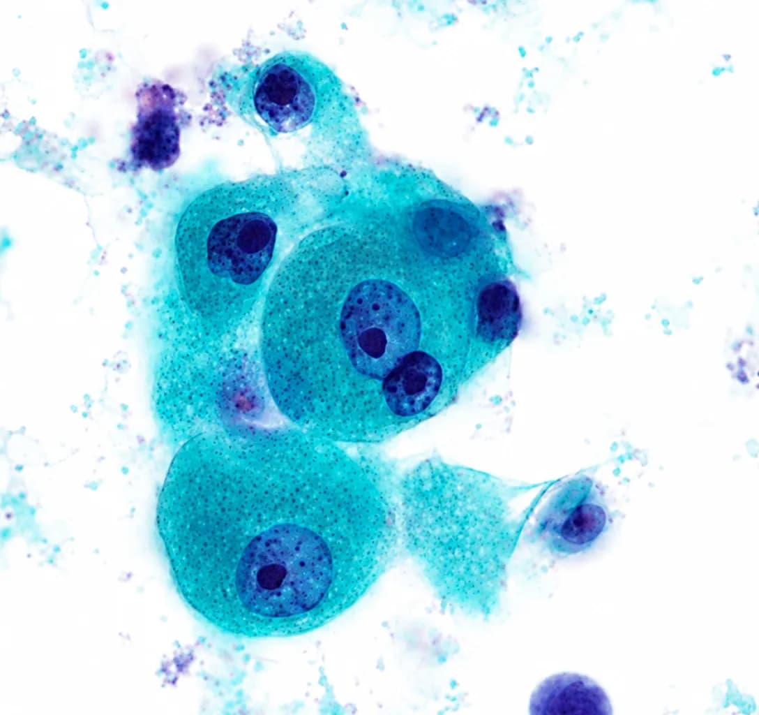 Types of Warthin’s Tumour