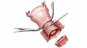 Radical trachelectomy: