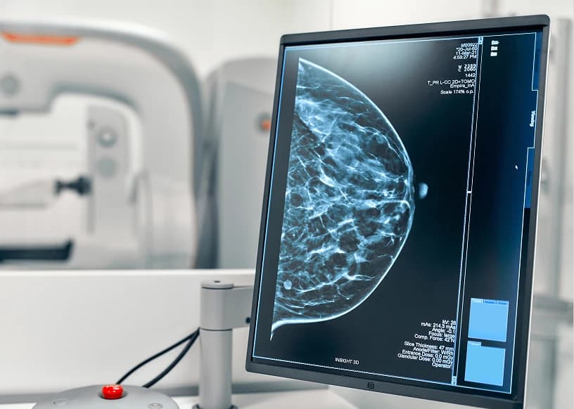 breast-cancer10