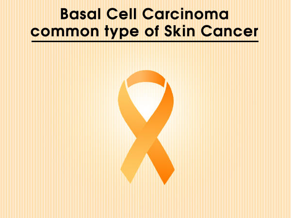 Basal Cell Carcinoma: Common Type of Skin Cancer 