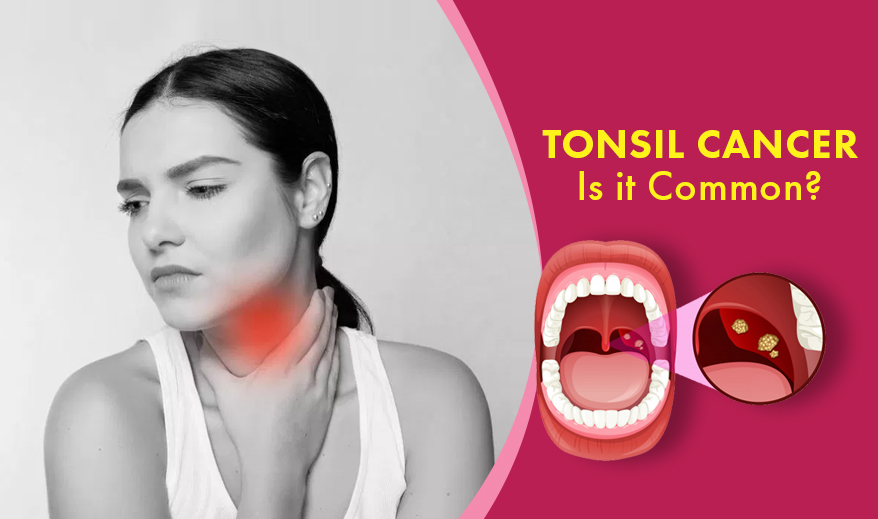 Tonsil Can 1543471411 